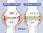 ひざ関節痛　Pain in knee joint
